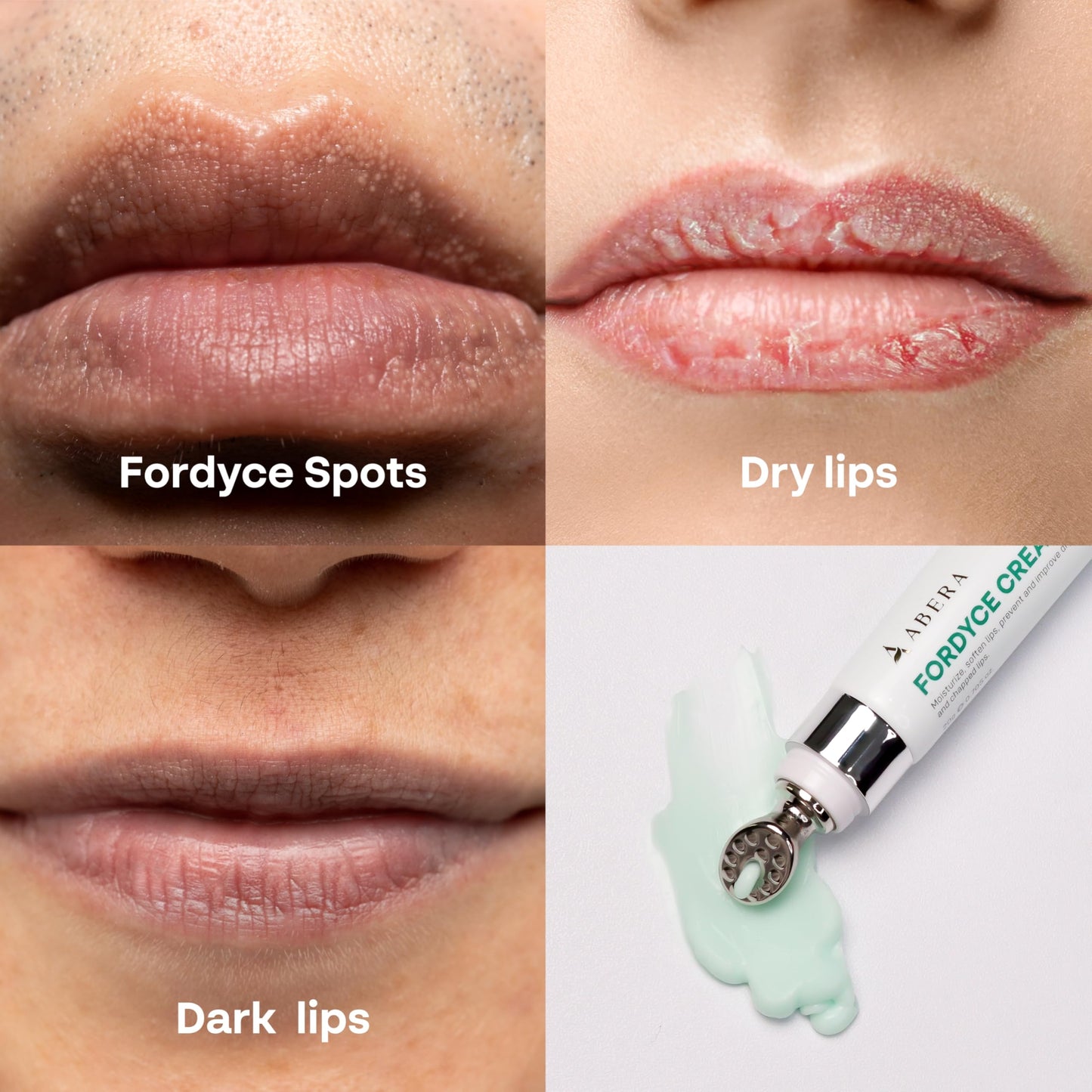 Abera Fordyce Cream - Advanced Formula with HPR (Next-Gen Retinoids), Fordyce Spot Remover For Lips, All-day Moisturizing, Help Improve Dry, Chapped Beauty and Personal Care ABERA