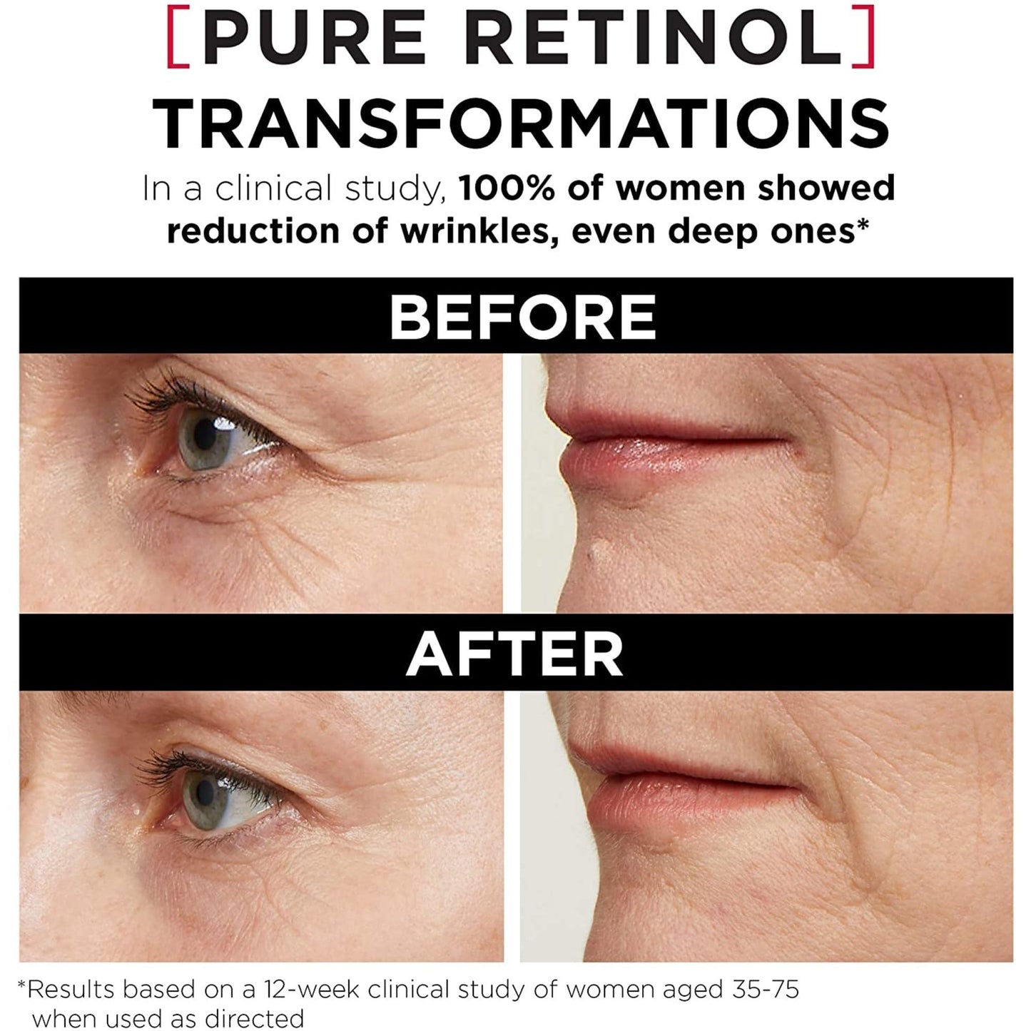 'L'Oreal Paris Revitalift Triple Power LZR Retinol Night Serum For Face, With 0.3% Pure Retinol, Moisturizes Skin and Eliminates Deep Wrinkles