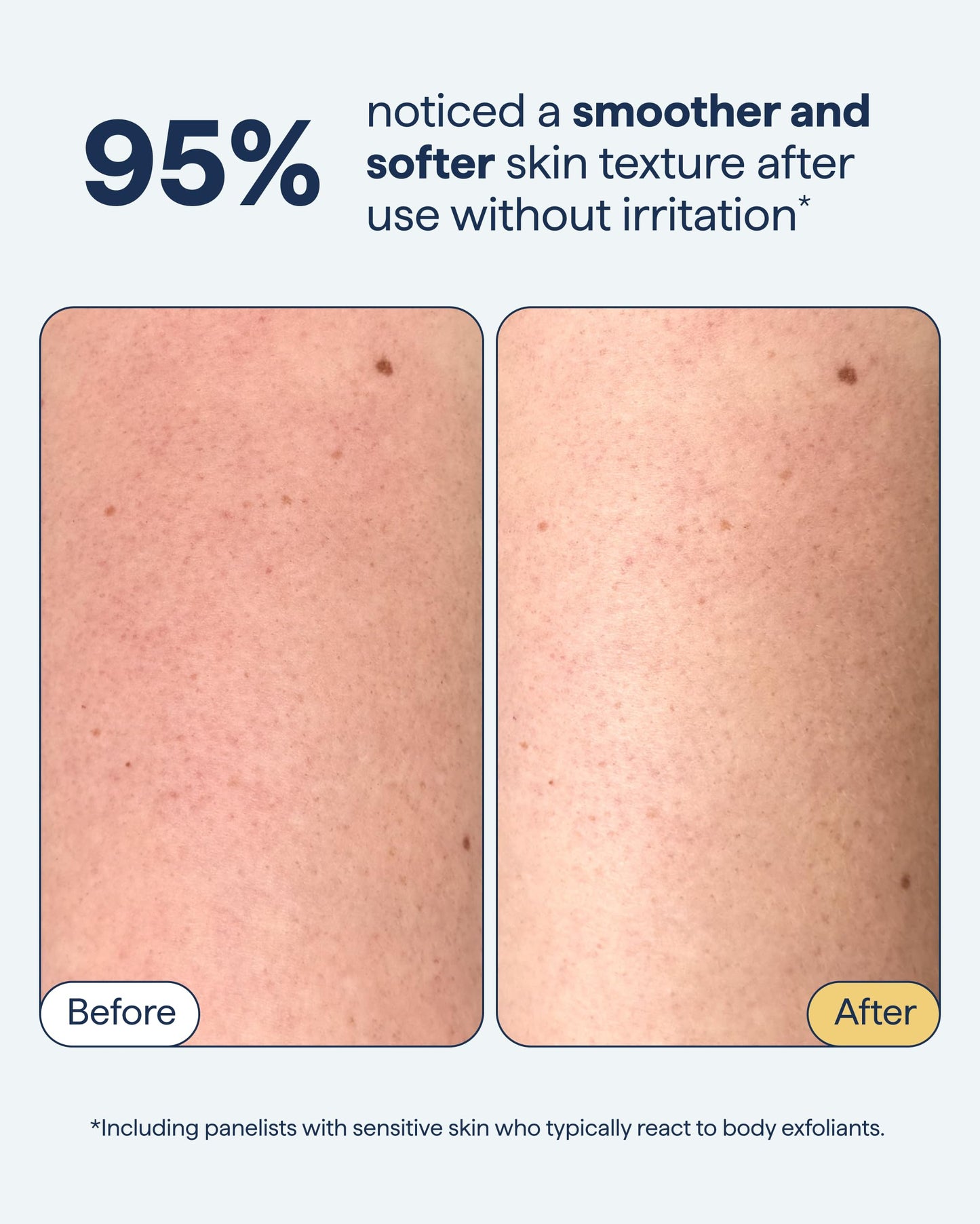 Remedy KP Exfoliating Body Scrub | Keratosis Pilaris and Chicken Skin Treatment with Fine Sugar, Glycolic Acid, Lactic Acid and Squalane | Exfoliating Beauty and Personal Care Remedy Science