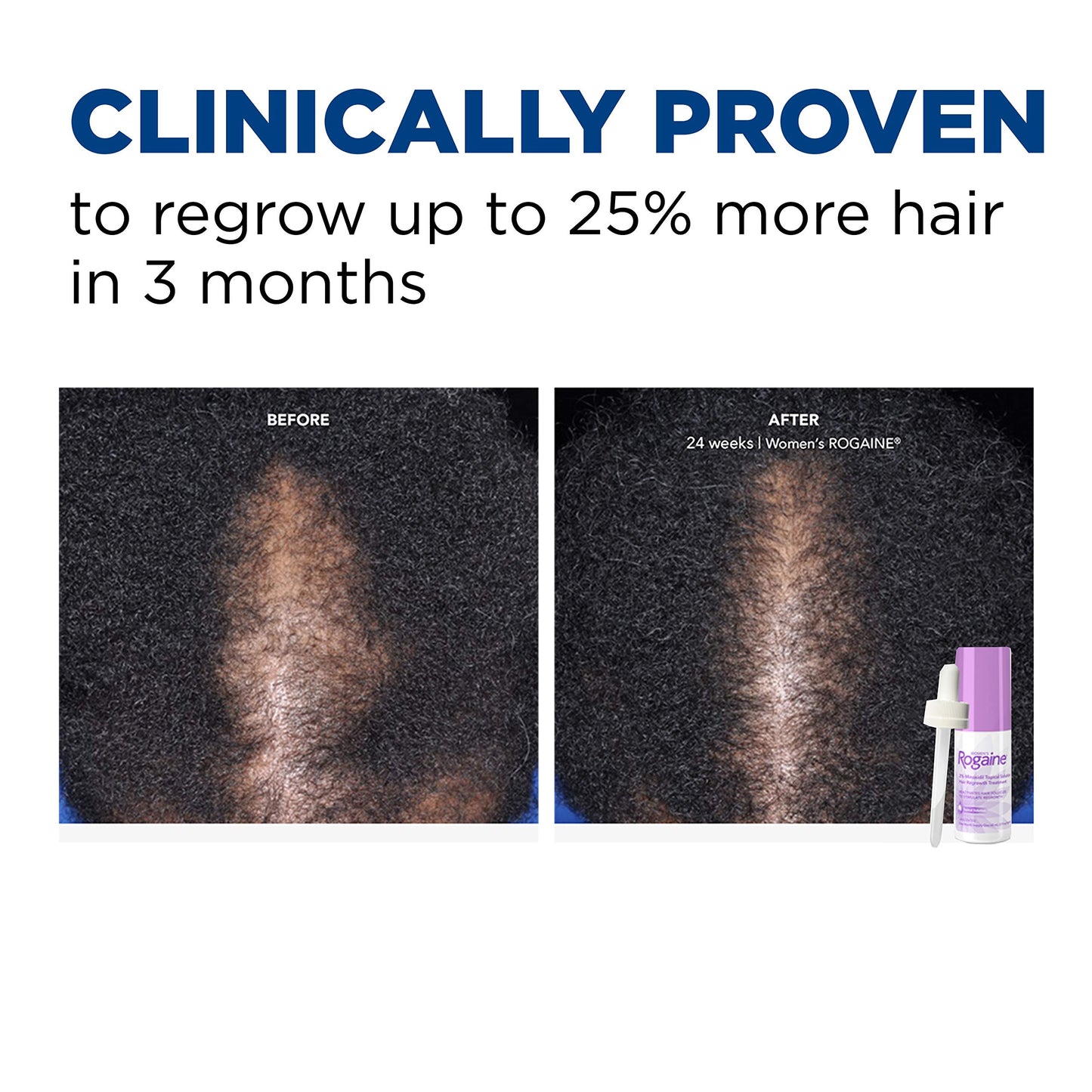 Women's Rogaine 2% Minoxidil Topical Solution for Hair Thinning and Loss, Topical Treatment for Women's Hair Regrowth, 3-Month Supply, Unscented Beauty and Personal Care Rogaine