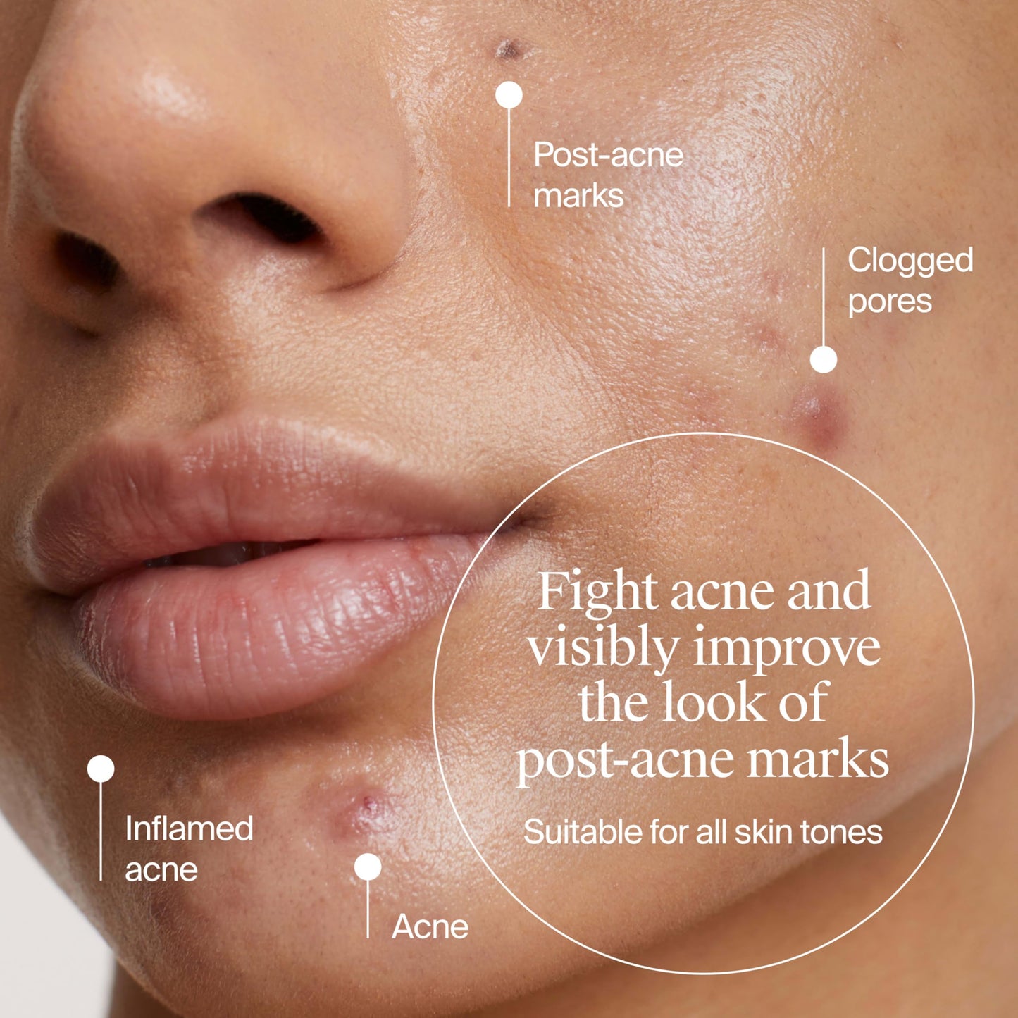 Neutrogena Evenly Clear Retinoid Adapalene Gel 0.1% Acne Spot Treatment, Once-Daily Topical Retinoid Helps Clear Breakouts & Visible Improvement in