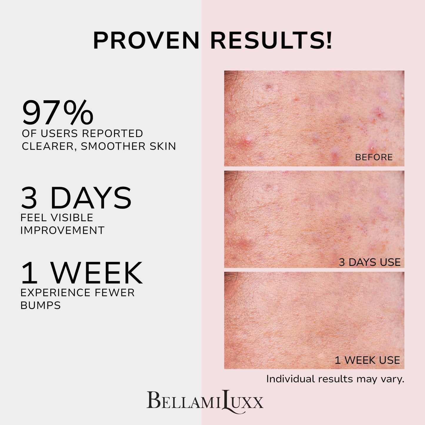 BellamiLuxx Butt Acne Clearing Treatment Cream: Body Acne Treatment for Folliculitis and Pimples on Buttocks, Thighs, and Body with 2% Salicylic Acid Beauty and Personal Care BellamiLuxx