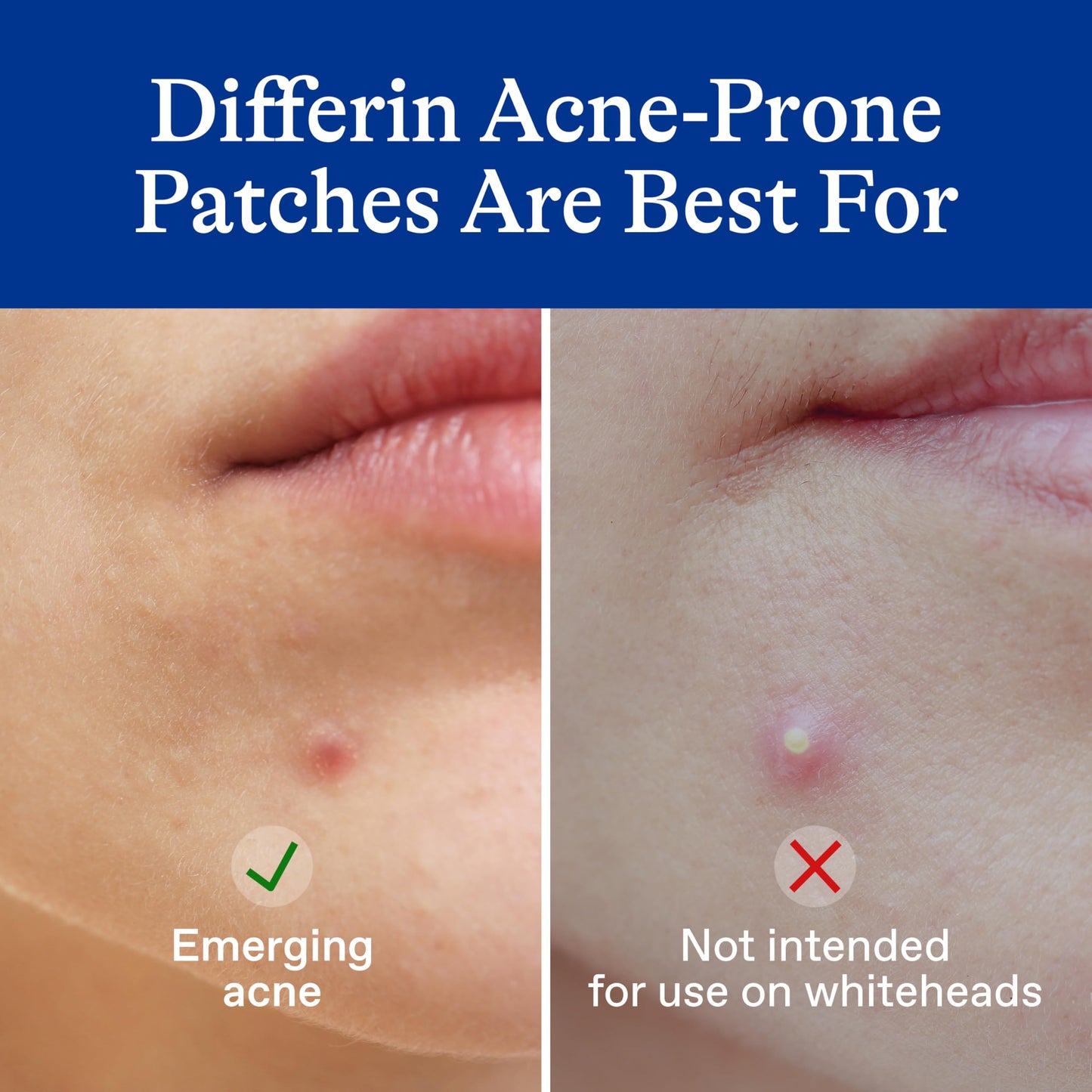 Differin Acne Patches, Pimple Patches for Acne Prone Skin, Formulated with Salicylic Acid and Centella, Fast Triple Action Power Patch for Day