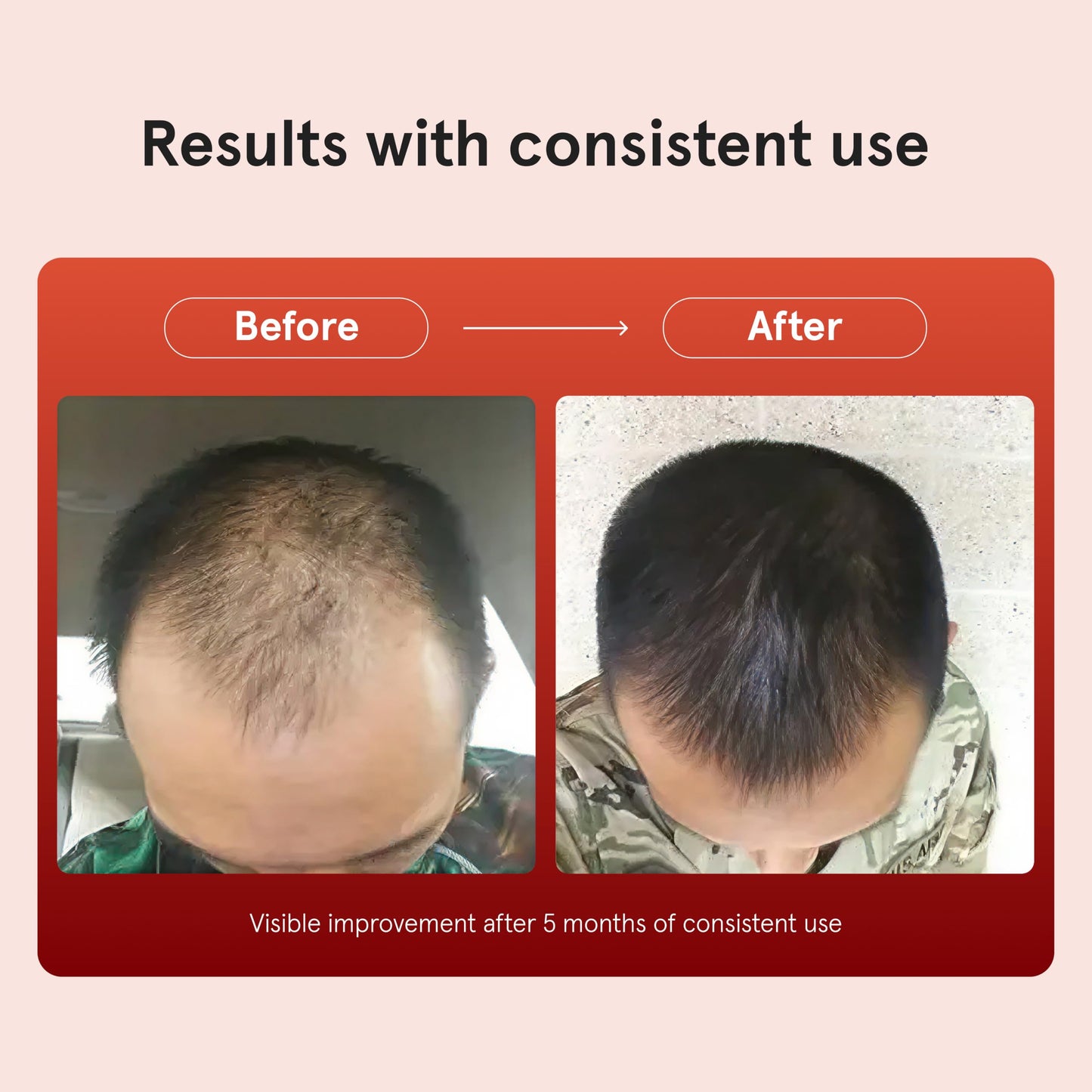 Keeps Minoxidil Solution 5% for Men, 3 Month Supply (3 x 2 fl oz Bottles) Beauty and Personal Care Keeps