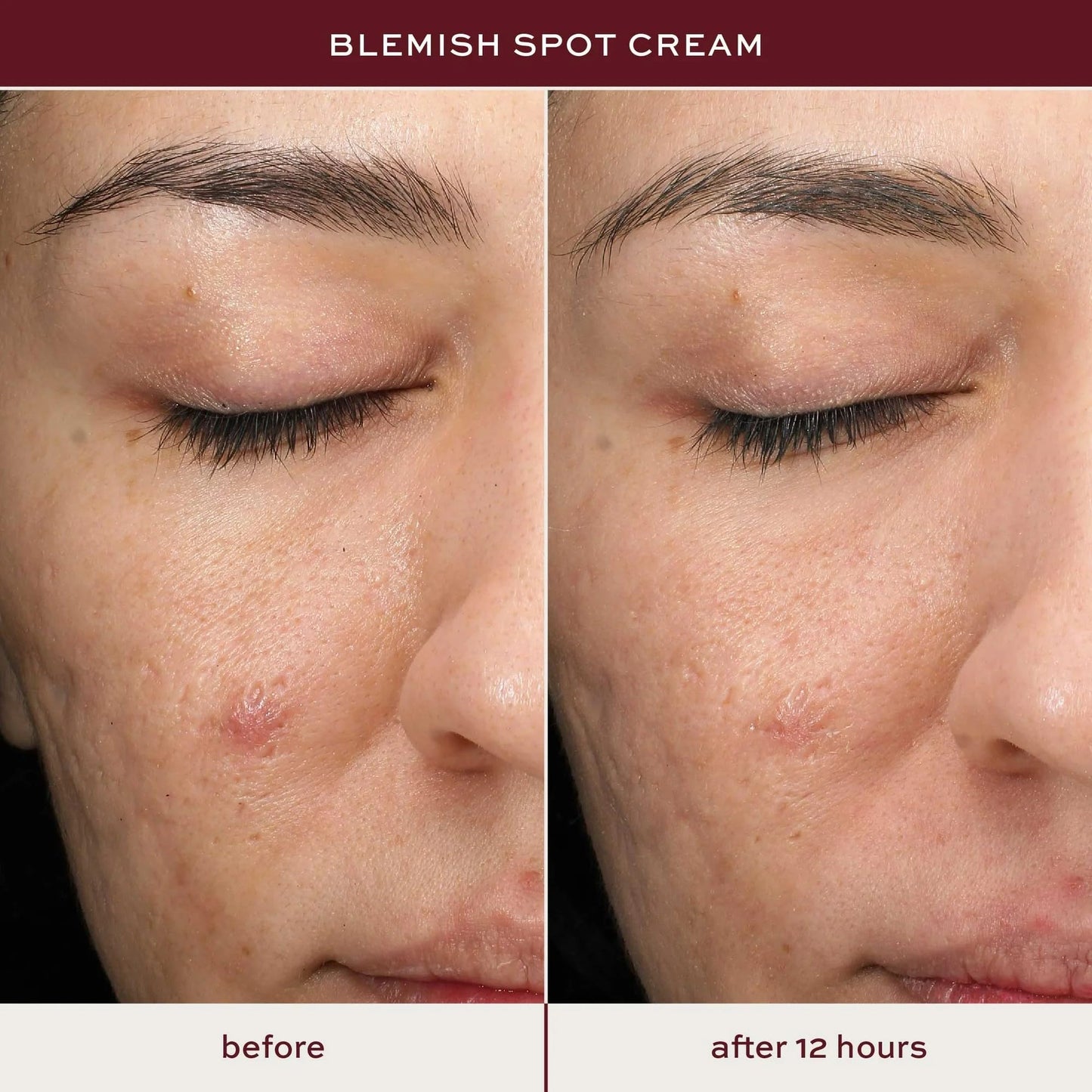 ITK Skincare Salicylic Acid Acne Spot Treatment for Face, Back & Body - Fast Active Acne Relief - Pimple Cream for Acne Prone Skin - Clear Blemishes