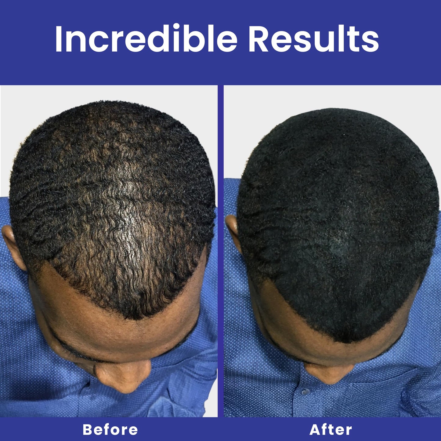 INFINITY Hair Fibers Medium Brown for Thinning Hair for Women & Men - 100% Undetectable Hair Building Fiber Powder - Conceal Hair Loss in 15 Seconds