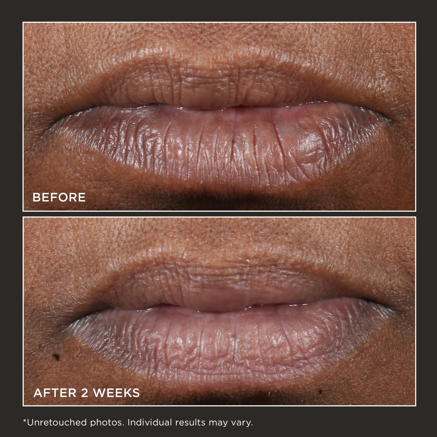 Perricone MD Cold Plasma Plus+ Lip Therapy