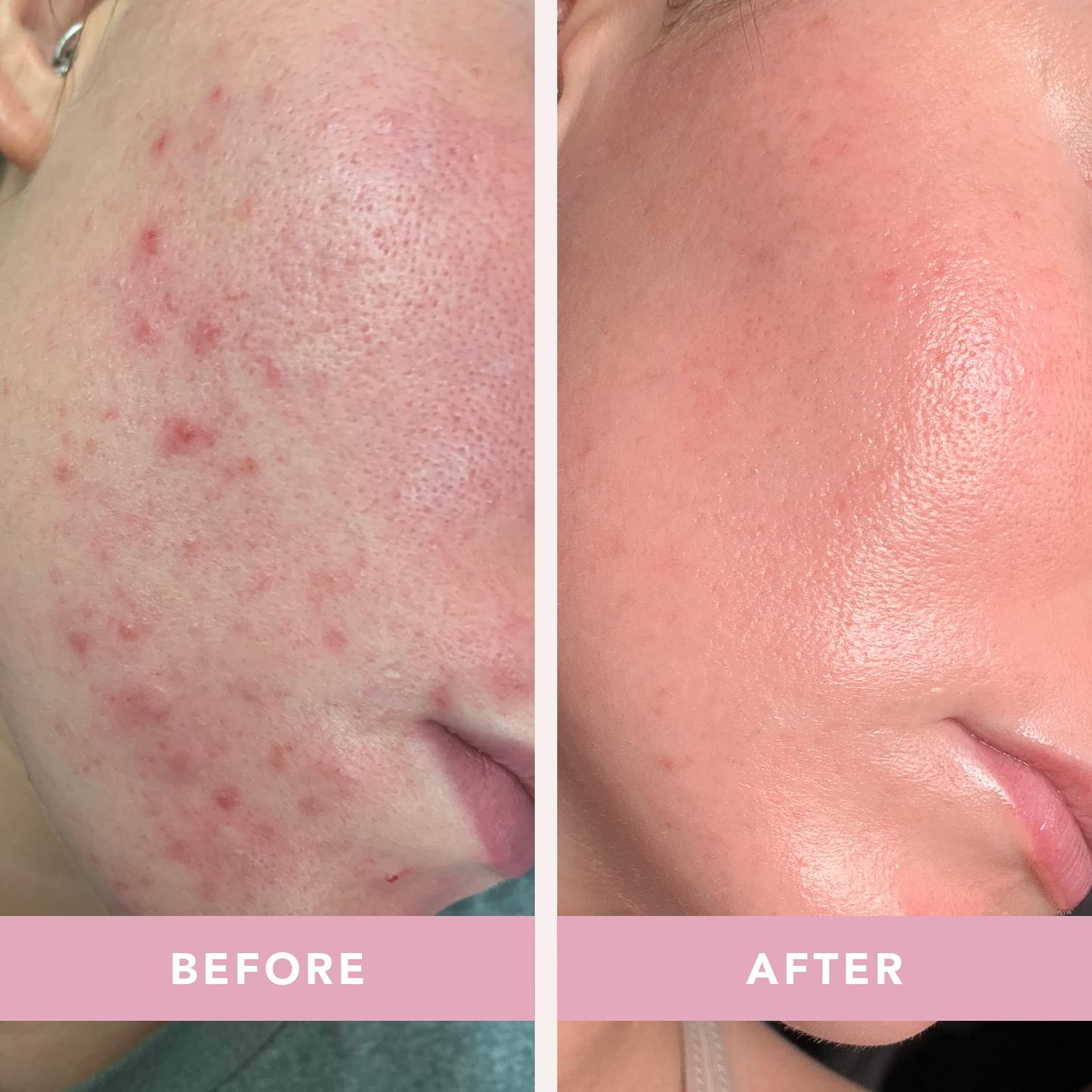 Doll 10 - Smooth Assist Overnight Facial 11% Triple-Acid Resurfacing Serum - Proven Overnight Transformation - Improves Skin Tone, Pores, Wrinkles