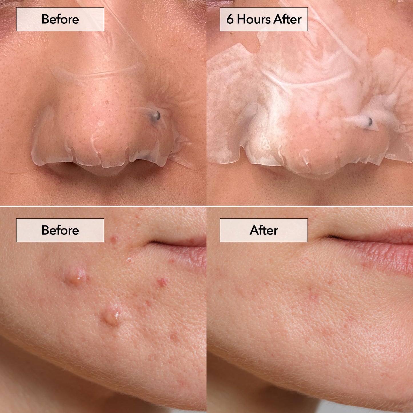 FreeGo Variety+ Hydrocolloid Spot Pimple & Pore Patches for Face, Large Patches for Breakouts, Zit, Blemish Spot, Facial Stickers, Korean Pimple