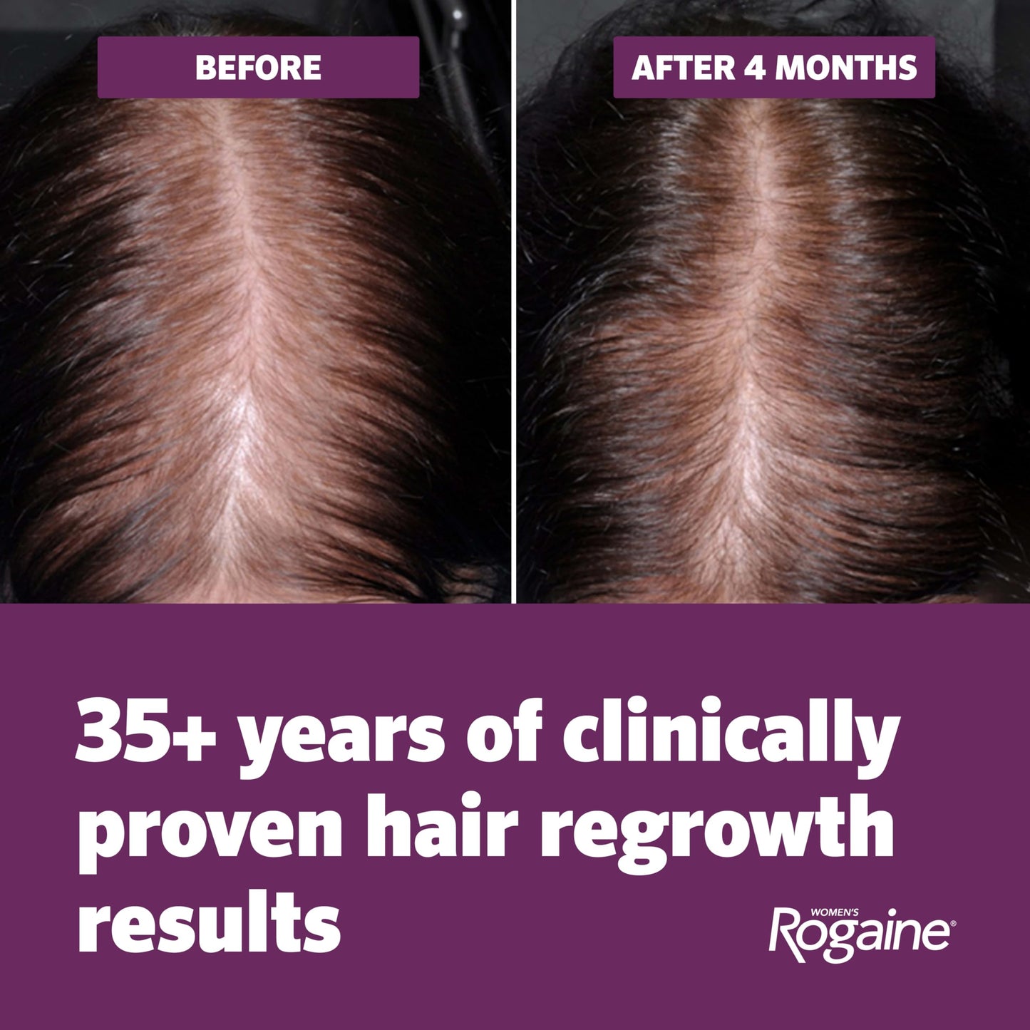 Women's Rogaine Hair Growth Foam, 5% Topical Minoxidil, 4 Mo, 2x 2.11 Oz Beauty and Personal Care Rogaine