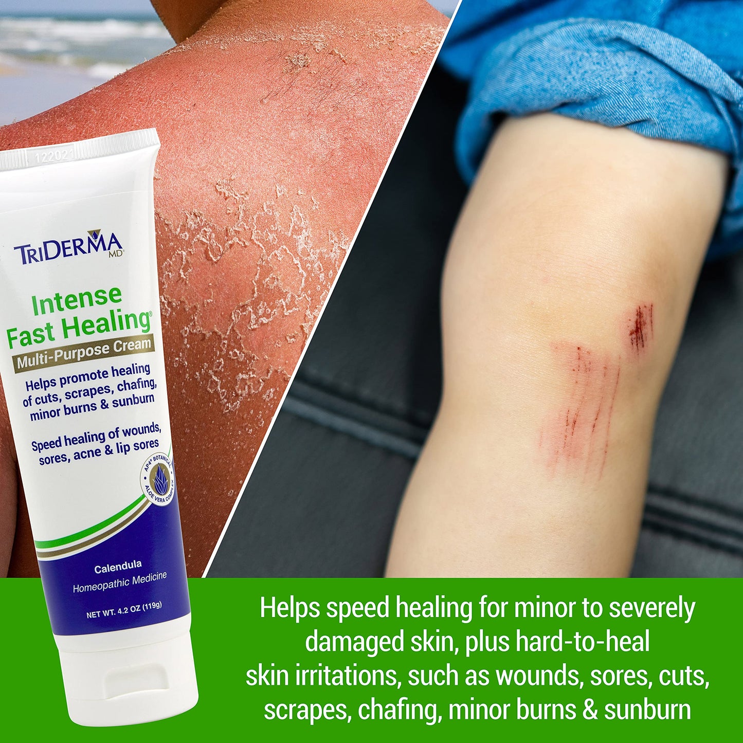 TriDerma Intense Fast Skin Healing Cream for Hard-to-Heal Skin Irritations, Sores, Rashes, Dry, Cracked Hands, Cuts, Chafing, Burns, Scrapes - First