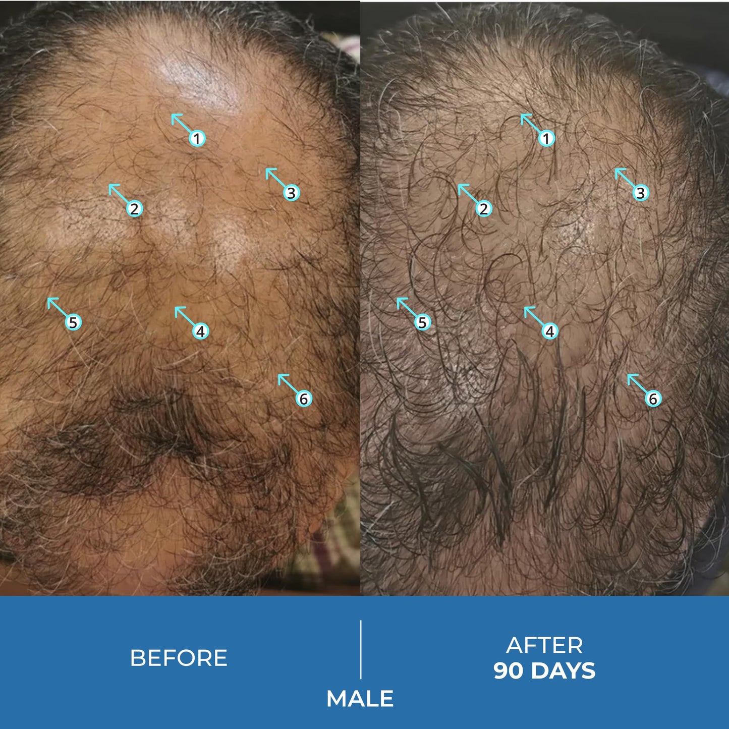 DS Labs Spectral.UHP 5% Minoxidil - Hair Density Serum, Extra Strength Topical Formula for Thicker-Looking Hair, Targets Thinning at the Crown Area Beauty & Personal Care DS Laboratories